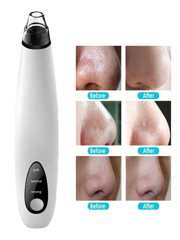 Blackhead Vacuum Remover